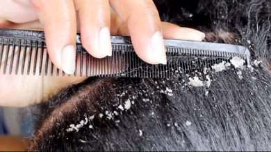درمان شوره سر و ریزش مو در خانم‌ها و آقایان