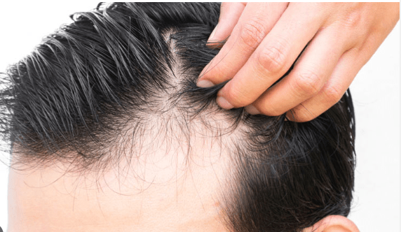 afc5ce1d bf41 42bc adff 22b02096f30b - راه درمان شوره سر و ریزش مو در خانم‌ها و آقایان