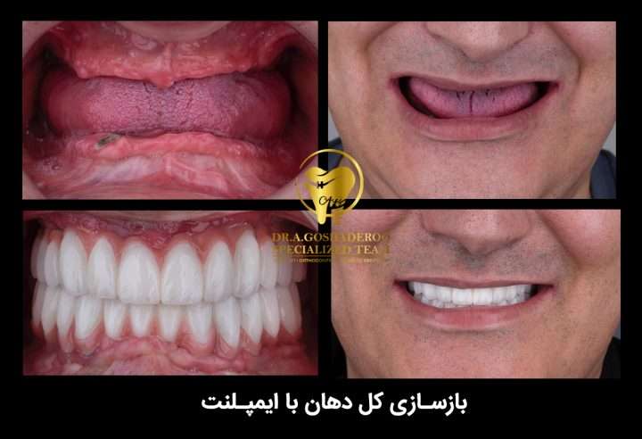 66bb91f1 f066 4294 9da7 e3bb99875707 720x492 - بازسازی کامل دهان و دندان