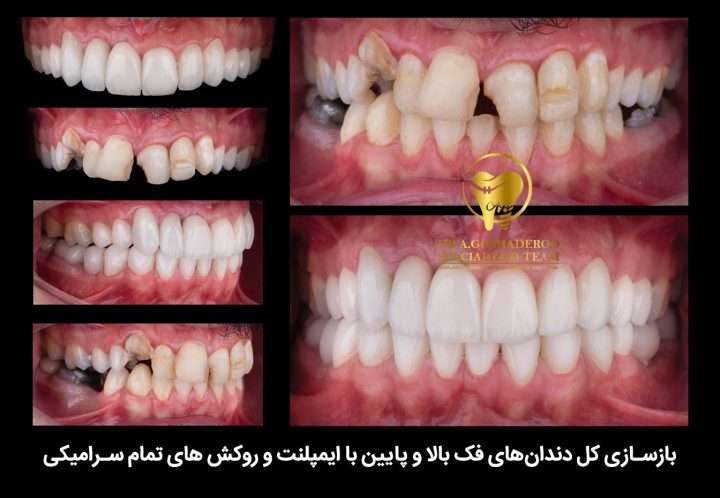 b0208575 2fea 46b0 ac09 debd72f32a54 720x498 - بازسازی کامل دهان و دندان
