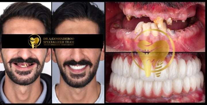 fe94e91a b31b 4395 ab51 f2d1a31c8a52 720x367 - بازسازی کامل دهان و دندان