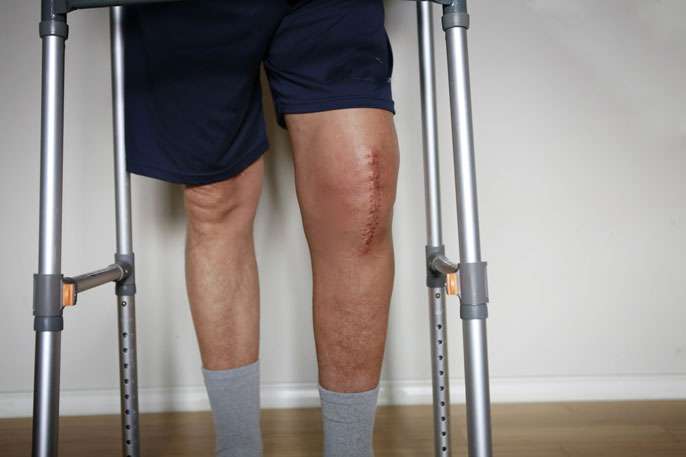 knee replacement 1 - هرآنچه که باید درباره ورم پا بعد از جراحی تعویض مفصل زانو بدانید