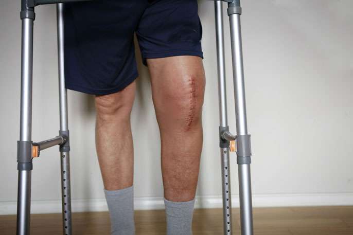 هرآنچه که باید درباره ورم پا بعد از جراحی تعویض مفصل زانو بدانید knee replacement 1 - هرآنچه که باید درباره ورم پا بعد از جراحی تعویض مفصل زانو بدانید