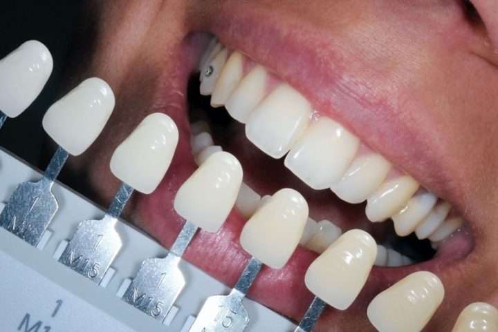 9afcdf45 38a6 440f b9c5 014796b08535 720x481 - بهترین ارائه دهندگان خدمات پزشکی کامپوزیت دندان (ونیر) + قیمت