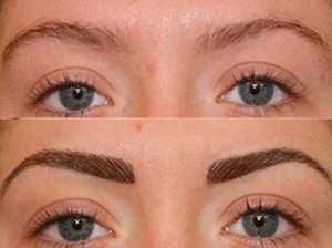 Eyebrows transplant 1 300x224 -