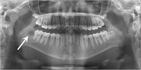 32cb795d ab65 4d20 838e 0ae28628620f - آموزش خواندن عکس دندان و تشخیص پوسیدگی های آن