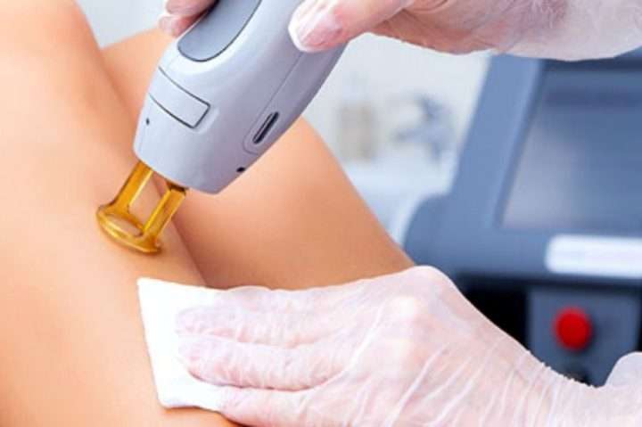 بهترین دستگاه لیزر موهای زائد
