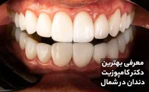 بهترین دکتر ونیر کامپوزیت دندان در شمال تهران