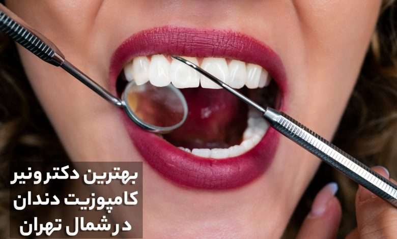 بهترین دکتر ونیر کامپوزیت دندان در شمال تهران