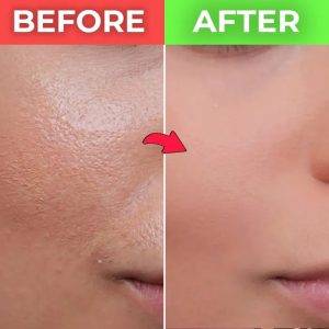 سرم اوردینری برای منافذ باز