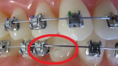 e618c65b 1875 41da a0f8 1f1feea74471 390x220 - از کجا بفهمیم براکت ارتودنسی شکسته شده است؟