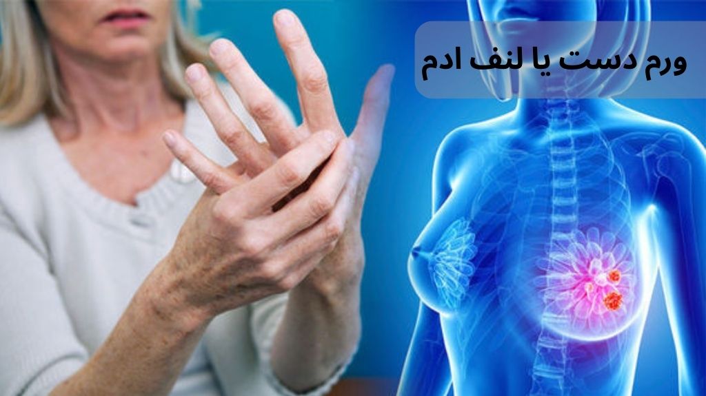 d9838383 82d1 4f19 93bb 9e383b2dd18f - پیشگیری از عوارض سرطان سینه