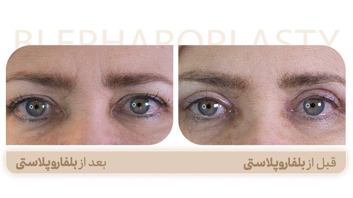 18a096a6 bca5 46fc 9f0f 1e0ed513f054 - تفاوت کانتوپلاستی و بلفاروپلاستی؛ انتخاب هوشمندانه برای زیبایی چشم ها