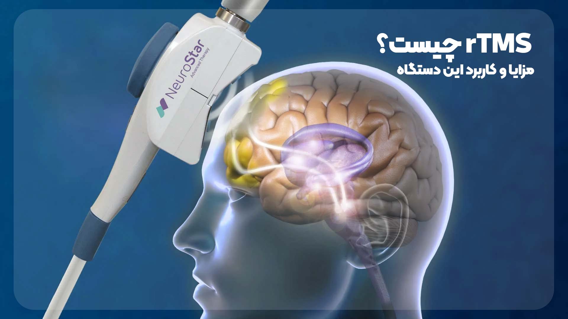 c2582b31 a6fc 475f b554 1a73e949566b - دستگاه آر تی ام اس (rTMS) چیست؟ بررسی جامع، کاربردها، مزایا و معایب
