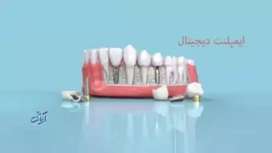برش ایمپلنت دیجیتال