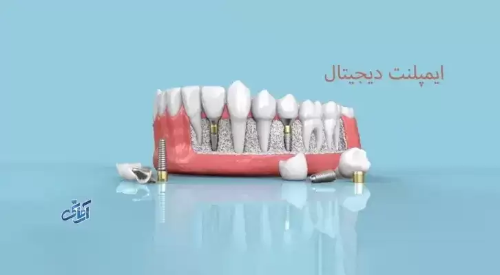 ایمپلنت-دیجیتال برش ایمپلنت دیجیتال