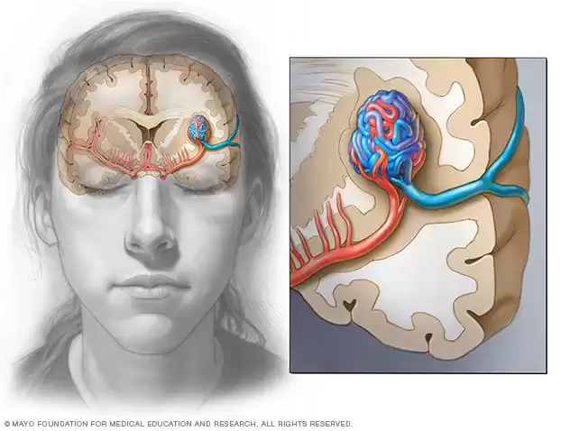 سردرد: راهنمای جامع انواع، علائم خطرناک و جدیدترین درمانها mcdc7 brain avm head 8col - سردرد: راهنمای جامع انواع، علائم خطرناک و جدیدترین درمانها