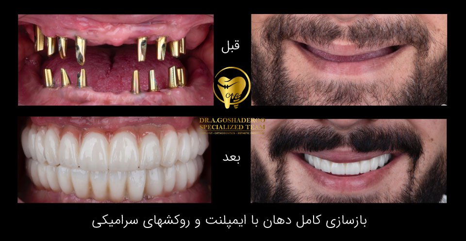 ایمپلنت کامل دهان