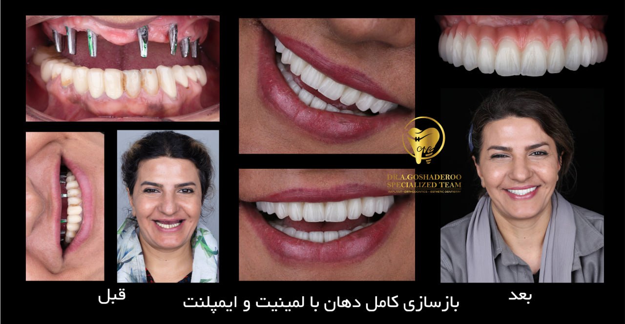 بازسازی کامل دهان با لمینت و ایمپلنت