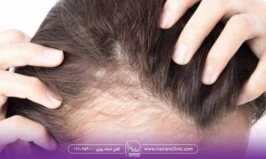eff08cba ba92 497c a99d acc74cd149f3 - برای جلوگیری از ریزش مو چه بخوریم​؟
