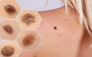 روش‌های درمان خال گوشتی