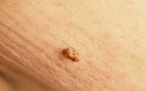 علل شکل گیری خال گوشتی