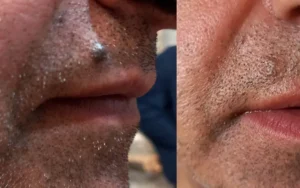 خال گوشتی چیست