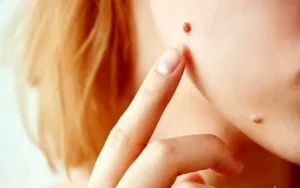 علل شکل‌گیری خال گوشتی + روش‌های درمان و مراقبت