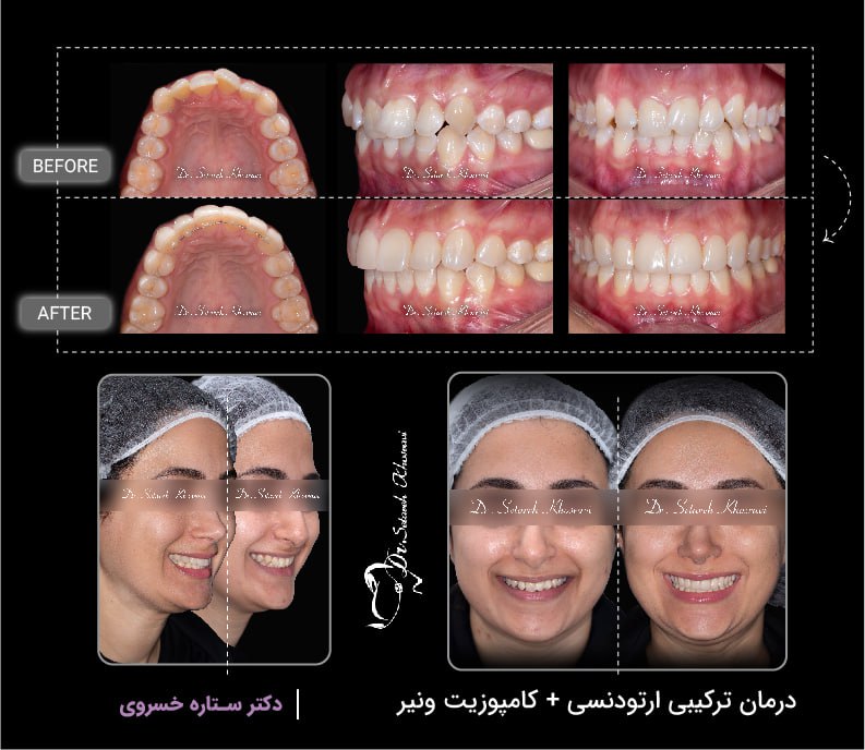 درمان ترکیبی ارتودنسی و کامپوزیت ونیر