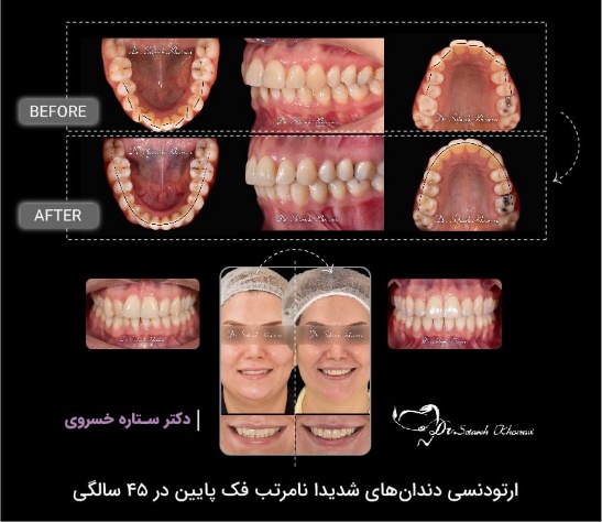 ارتودنسی دندان های شدیدا نامرتب در بیمار 45 ساله