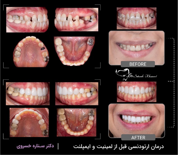 درمان ارتودنسی قبل از لمینت و ایمپلنت