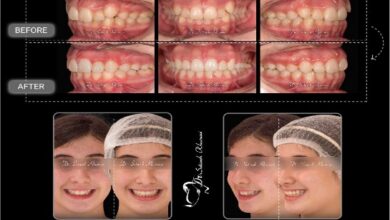 اصلاح طرح لبخند با ارتودنسی