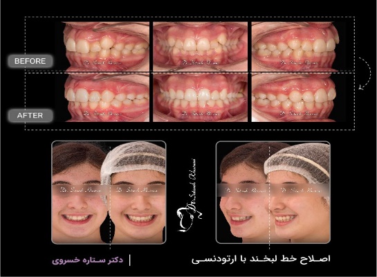 اصلاح طرح لبخند با ارتودنسی