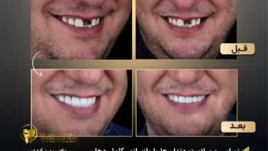 ایمپلنت فوری