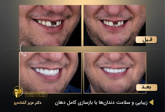 ایمپلنت فوری