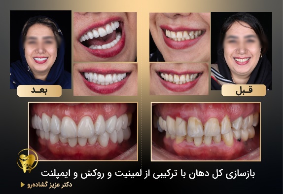 ایمپلنت یک روزه _ لمینیت دندان