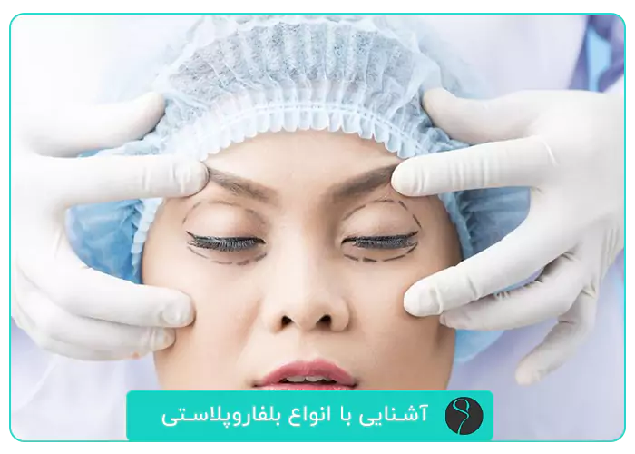 انواع بلفاروپلاستی