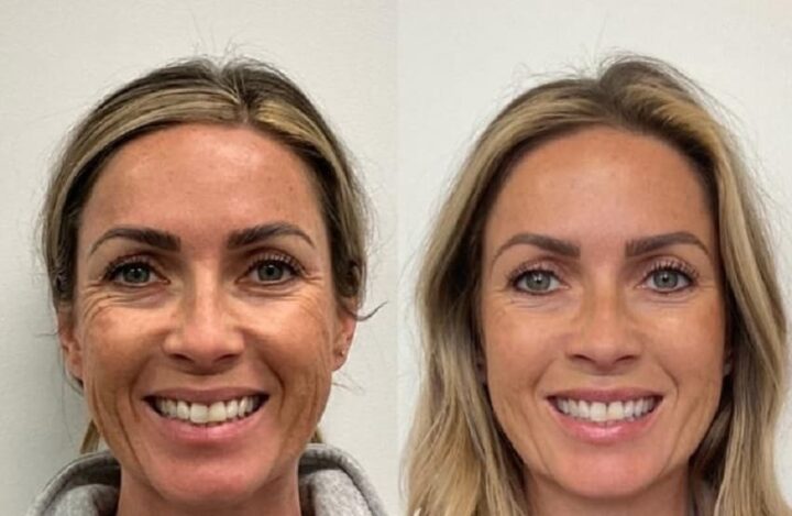 عکس قبل و بعد تزریق بوتاکس به صورت زن