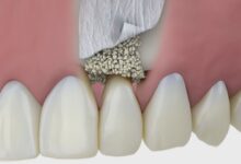 هزینه پودر استخوان ایمپلنت