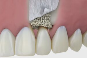 هزینه پودر استخوان ایمپلنت