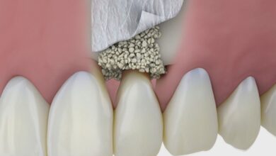 هزینه پودر استخوان ایمپلنت