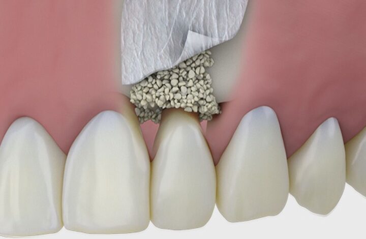 هزینه پودر استخوان ایمپلنت