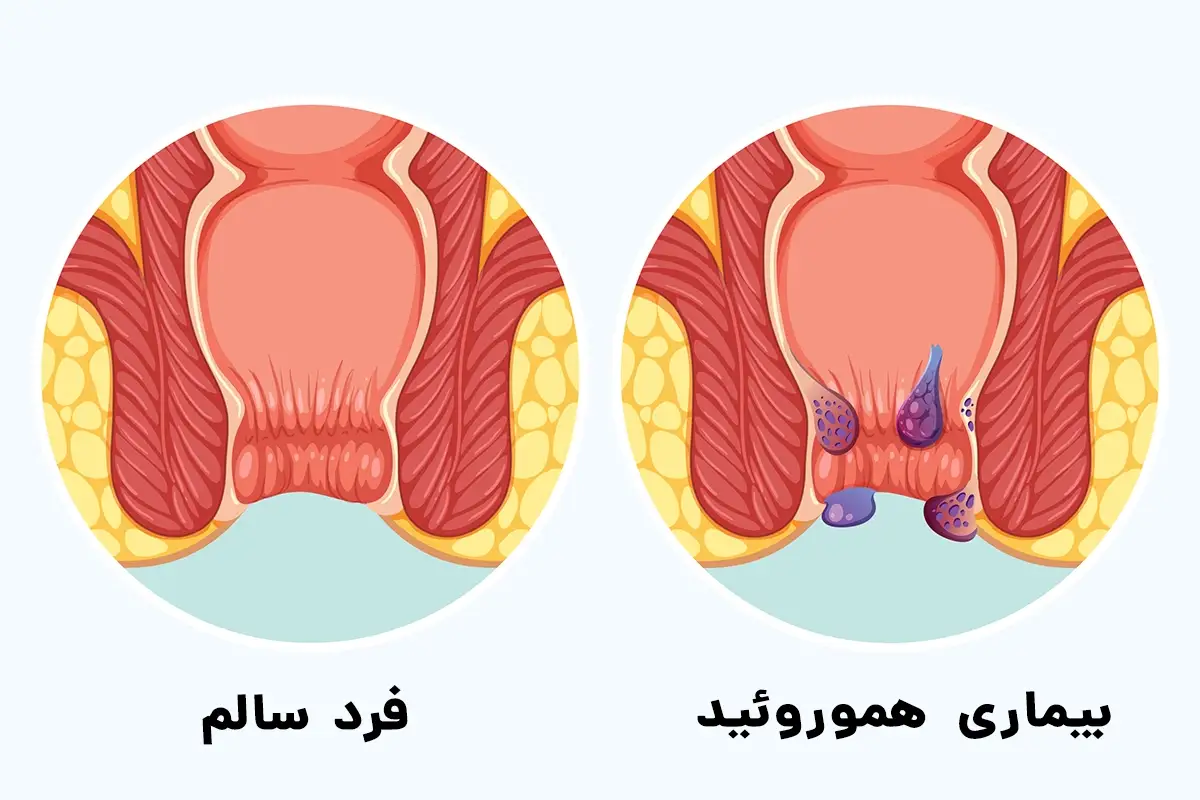 بیماری هموروئید