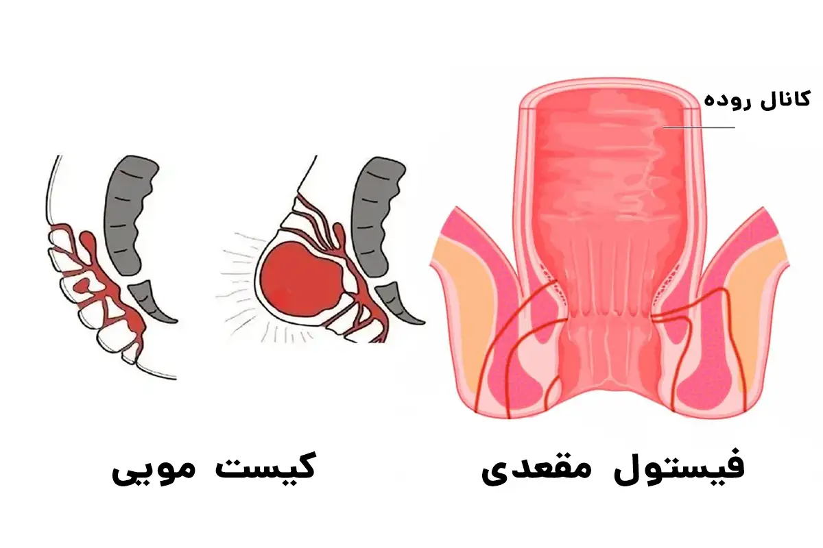 فیستول و کیست مویی