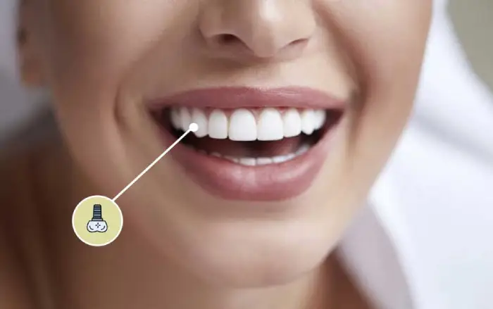 قیمت ایمپلنت دندان در 1403 [ لیست قیمت + مشاوره رایگان ]