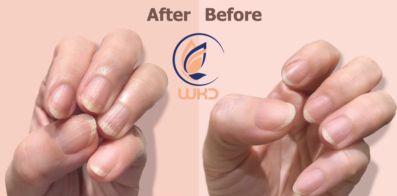 قبل و بعد از استفاده از روغن ناخن WKD