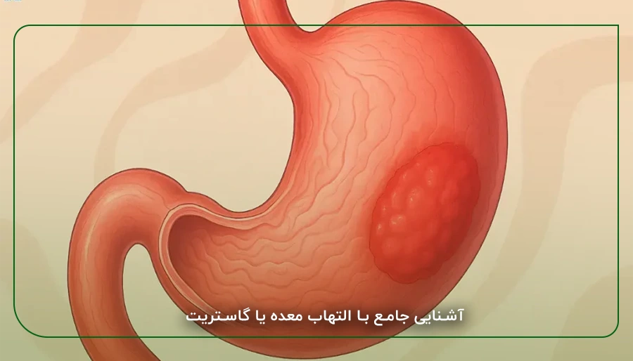 التهاب معده