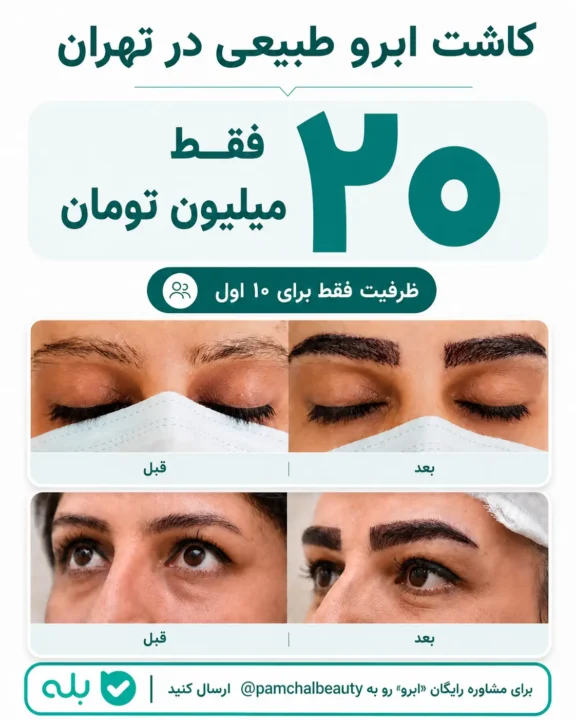 قیمت کاشت ابرو 