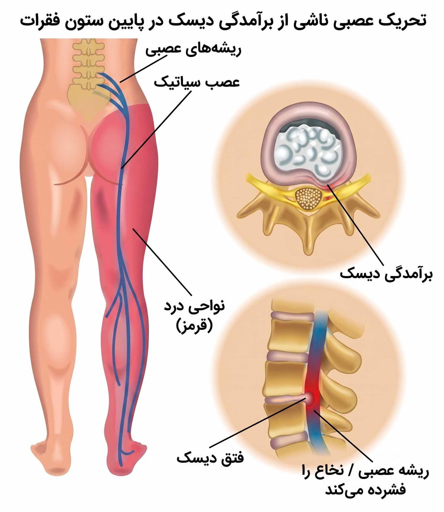 درمان بی حسی پا بعد از جراحی