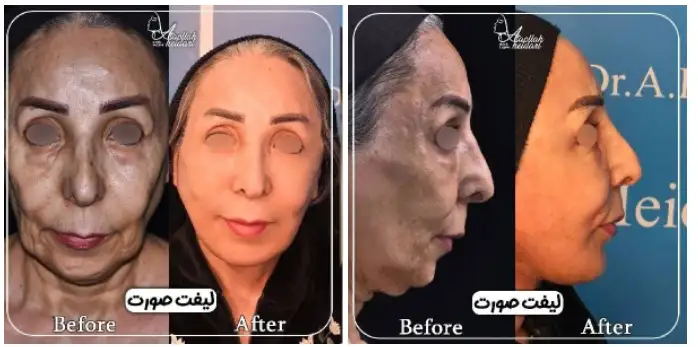 عکس نمونه کار جراحی لیفت صورت